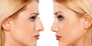 All You Need To Know About Rhinoplasty Surgery