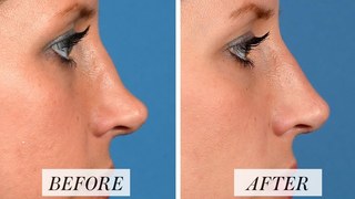 The Cosmetic And Medical Significance Of Rhinoplasty Surgery